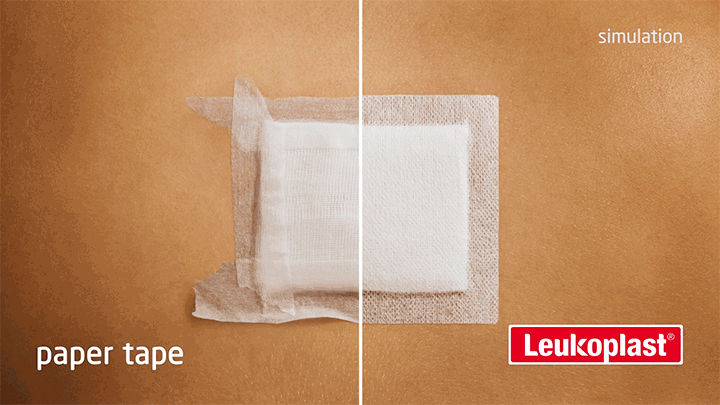 Close-up comparison of surgical tape vs wide area fixation performance on skin over time Close-up comparison of surgical tape vs wide area fixation performance on skin over time